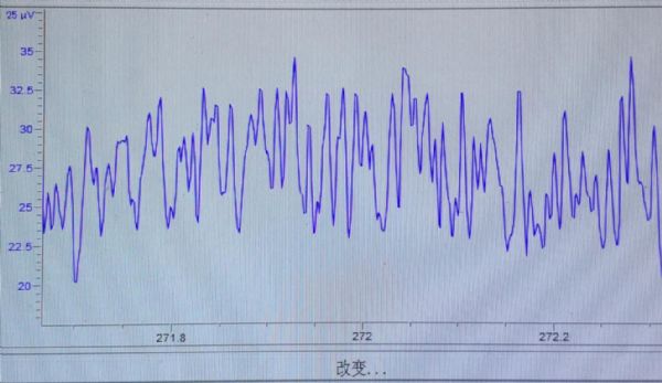 tcd基线不规则跳动